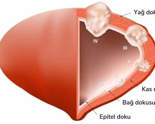 Mesane Nedir? Kapalı Mesane Tümörü Ameliyatı