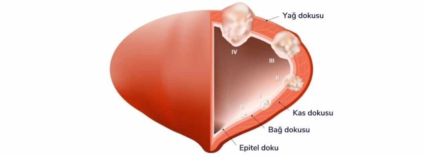 Mesane Nedir? Kapalı Mesane Tümörü Ameliyatı