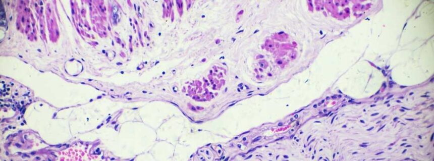 Prostat Biyopsisi Nedir?