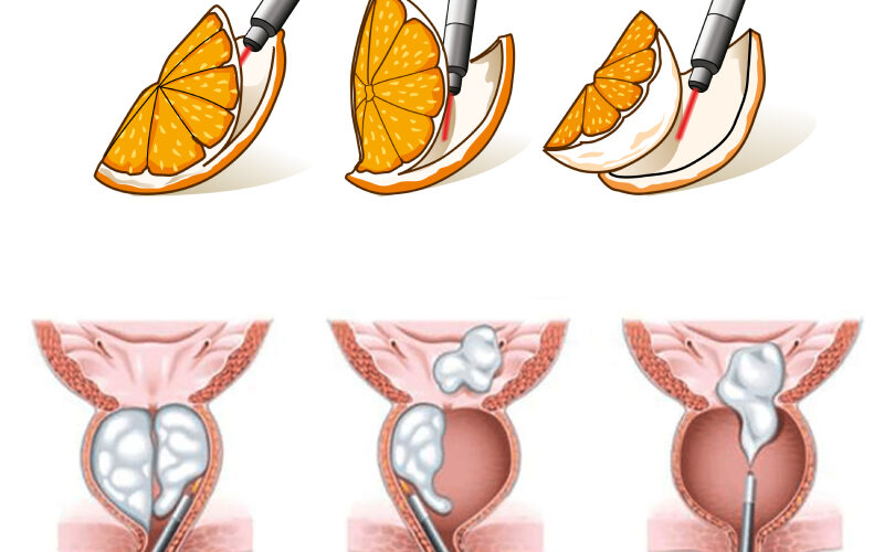 HoLEP Ameliyatı